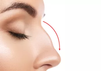 Burun Estetigi Oncesi