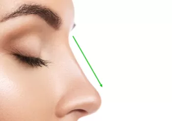 Burun Estetigi Sonrasi