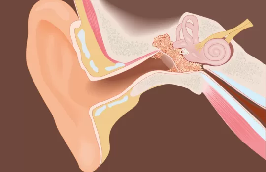 Kolesteatom Tedavisi 3