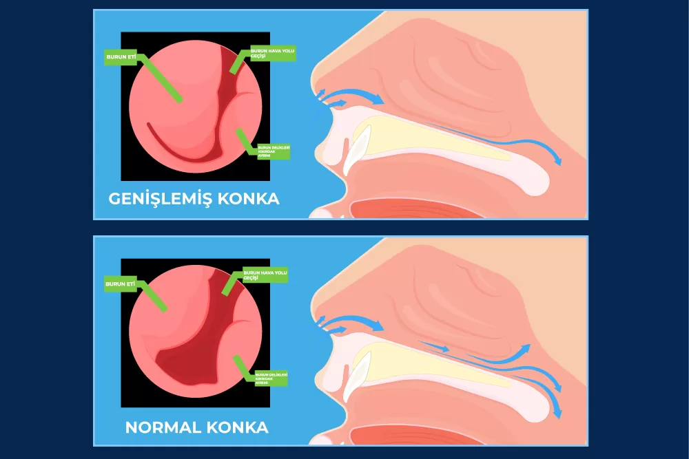 Konka Hipertrofisi 5