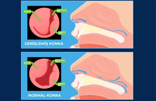 Konka Hipertrofisi 6