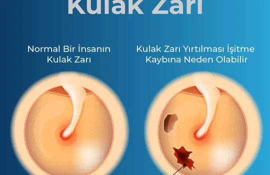 Kulak Zari Perforasyonu 3