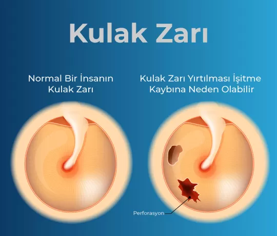 Kulak Zari Perforasyonu