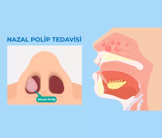 Nazal Polip Tedavisi