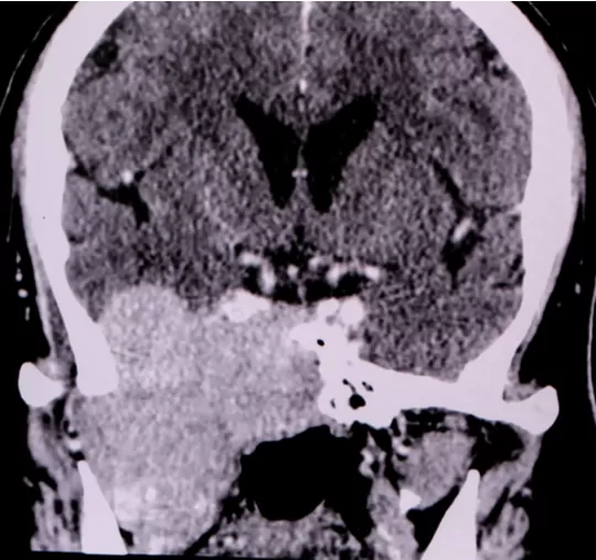 On Kafa Kaidesi Tumor Cerrahisi 5