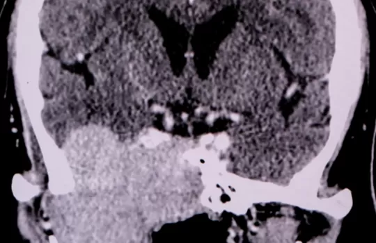 On Kafa Kaidesi Tumor Cerrahisi 6