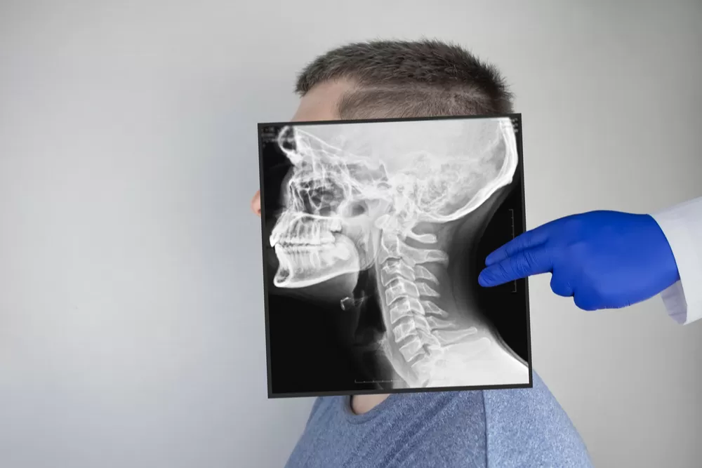 Yan Kafa Kaidesi Cerrahisi